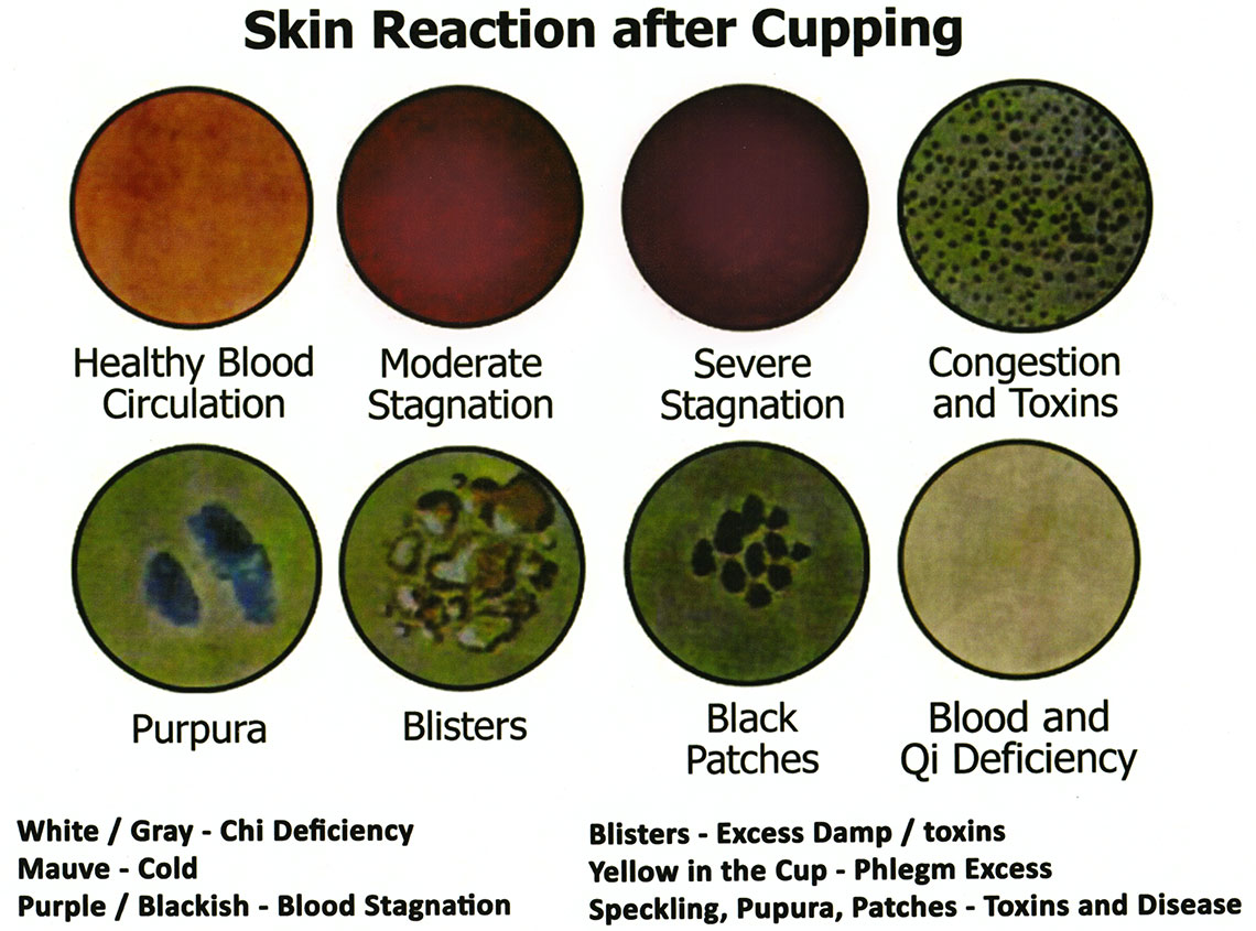 Cupping Therapy nur’ish
